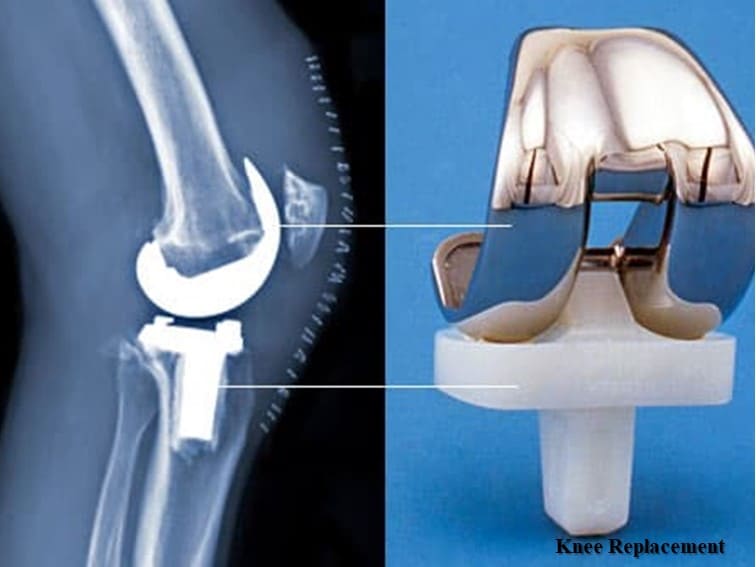 Total knee replacement in Hyderabad
