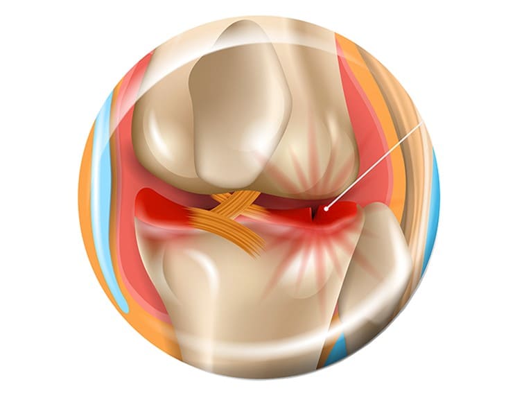 meniscus tear treatment in Hyderabad