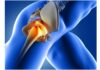 Osteoarthritis of the Hip Joint