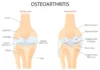 Osteoarthritis of the Knee Joint – Symptoms, Causes & Treatment